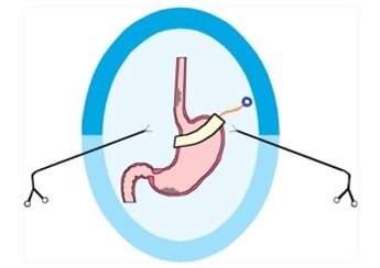 Upper GI and Bariatric surgery